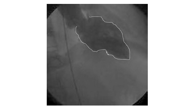 La linea tratteggiata indica i contorni del ventricolo sinistro durante la sistola cardiaca